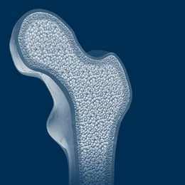 Detailansicht der Knochenstruktur (Spongiosa) im Oberschenkelhals zur Veranschaulichung von Osteoporose und verminderter Knochendichte.